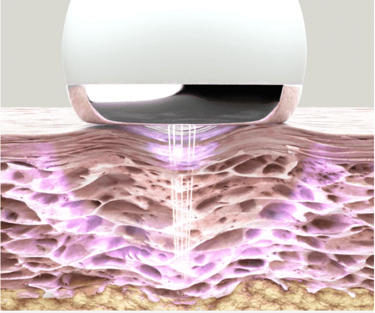 واحد - جهاز الكوري الذكي لعلاج مشاكل الزمن في البشرة| | (ONE) AGR - Usera Deep Shot
